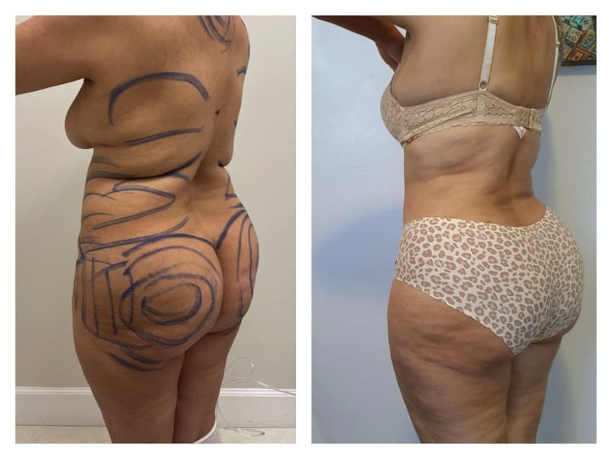 Tummy Tuck Before & After Gallery - Patient 133183818 - Image 3