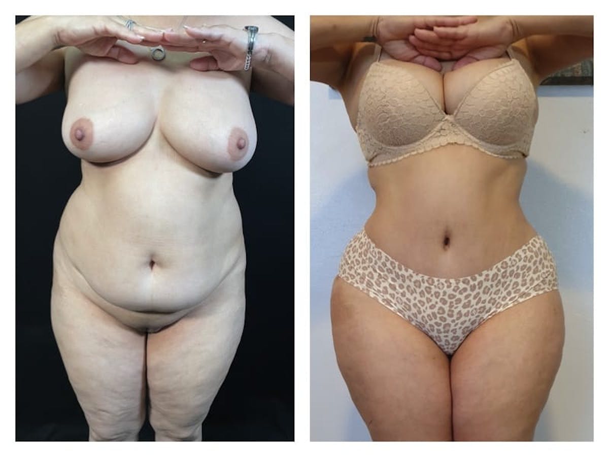 Tummy Tuck Before & After Gallery - Patient 133183818 - Image 1