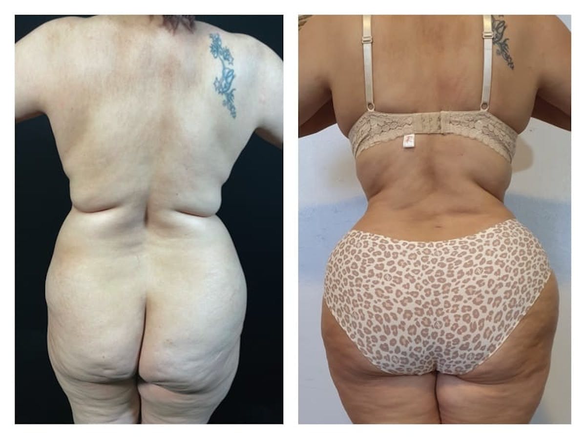 Tummy Tuck Before & After Gallery - Patient 133183818 - Image 2