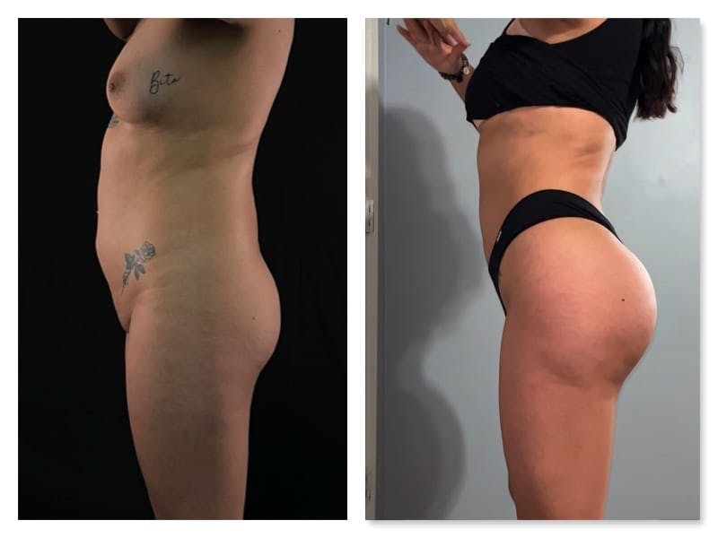 Brazilian Butt Lift Before & After Gallery - Patient 133183813 - Image 4