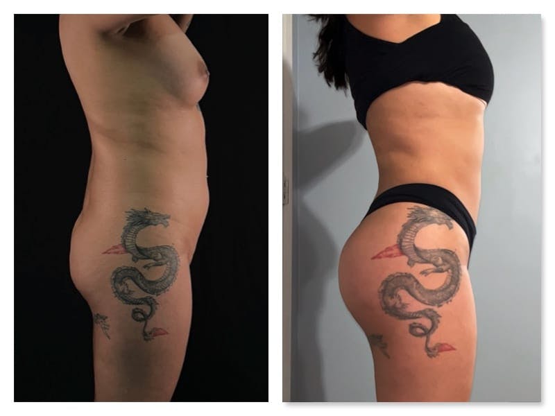 Brazilian Butt Lift Before & After Gallery - Patient 133183813 - Image 5