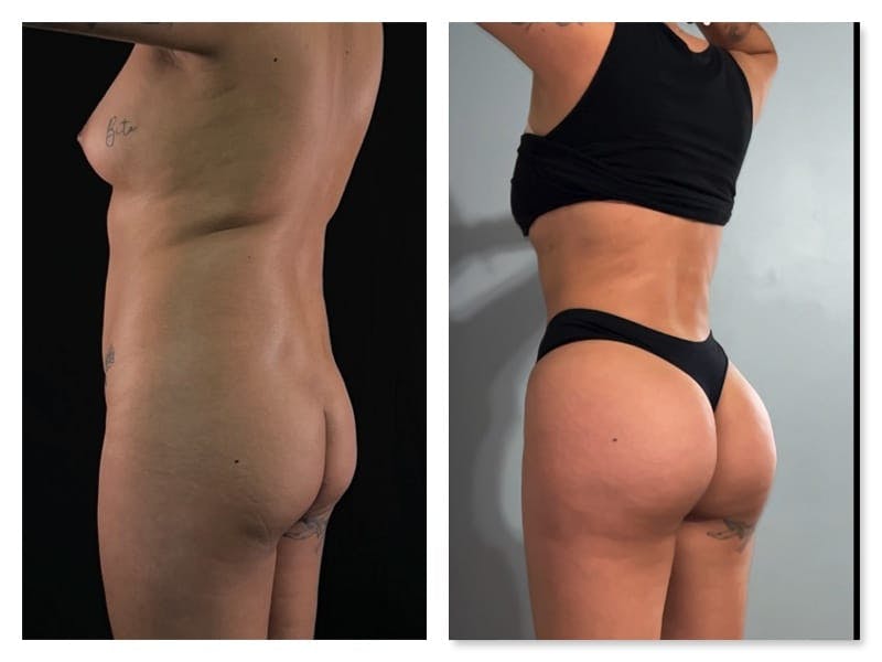 Brazilian Butt Lift Before & After Gallery - Patient 133183813 - Image 2
