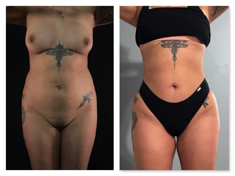 Brazilian Butt Lift Before & After Gallery - Patient 133183813 - Image 3