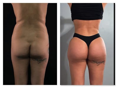 Brazilian Butt Lift Before & After Gallery - Patient 133183813 - Image 1