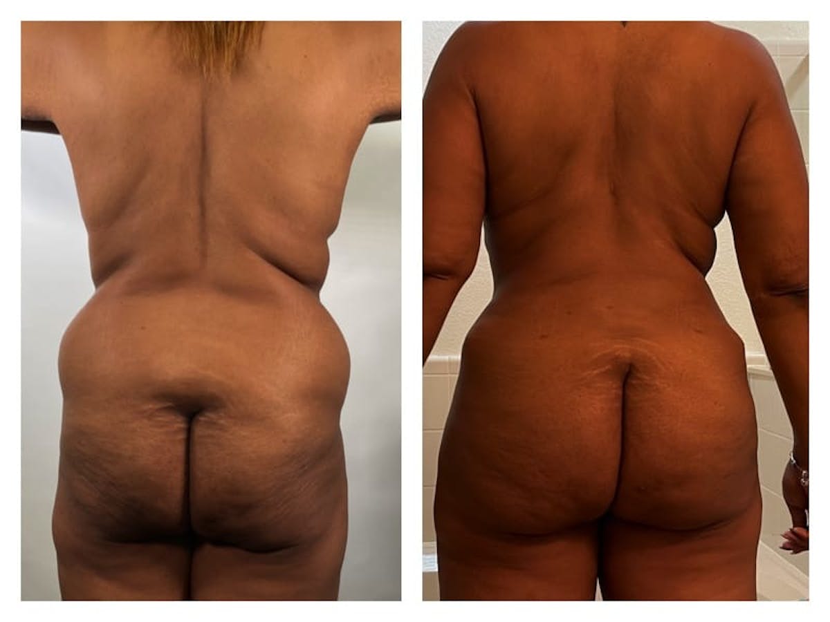 Mommy Makeover Before & After Gallery - Patient 133183893 - Image 2