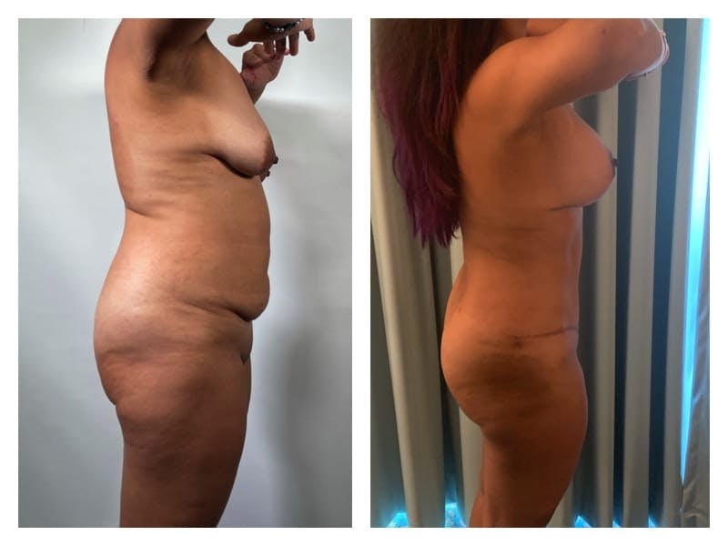 Mommy Makeover Before & After Gallery - Patient 133183803 - Image 4