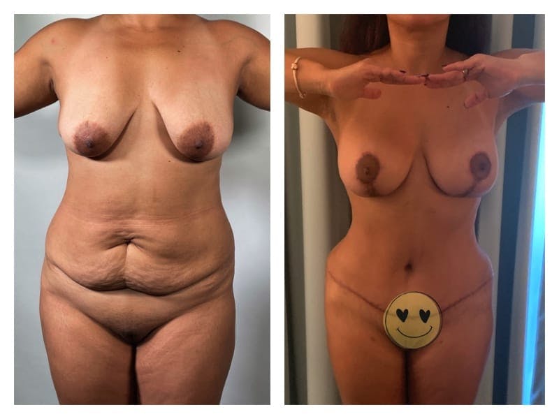 Mommy Makeover Before & After Gallery - Patient 133183803 - Image 1
