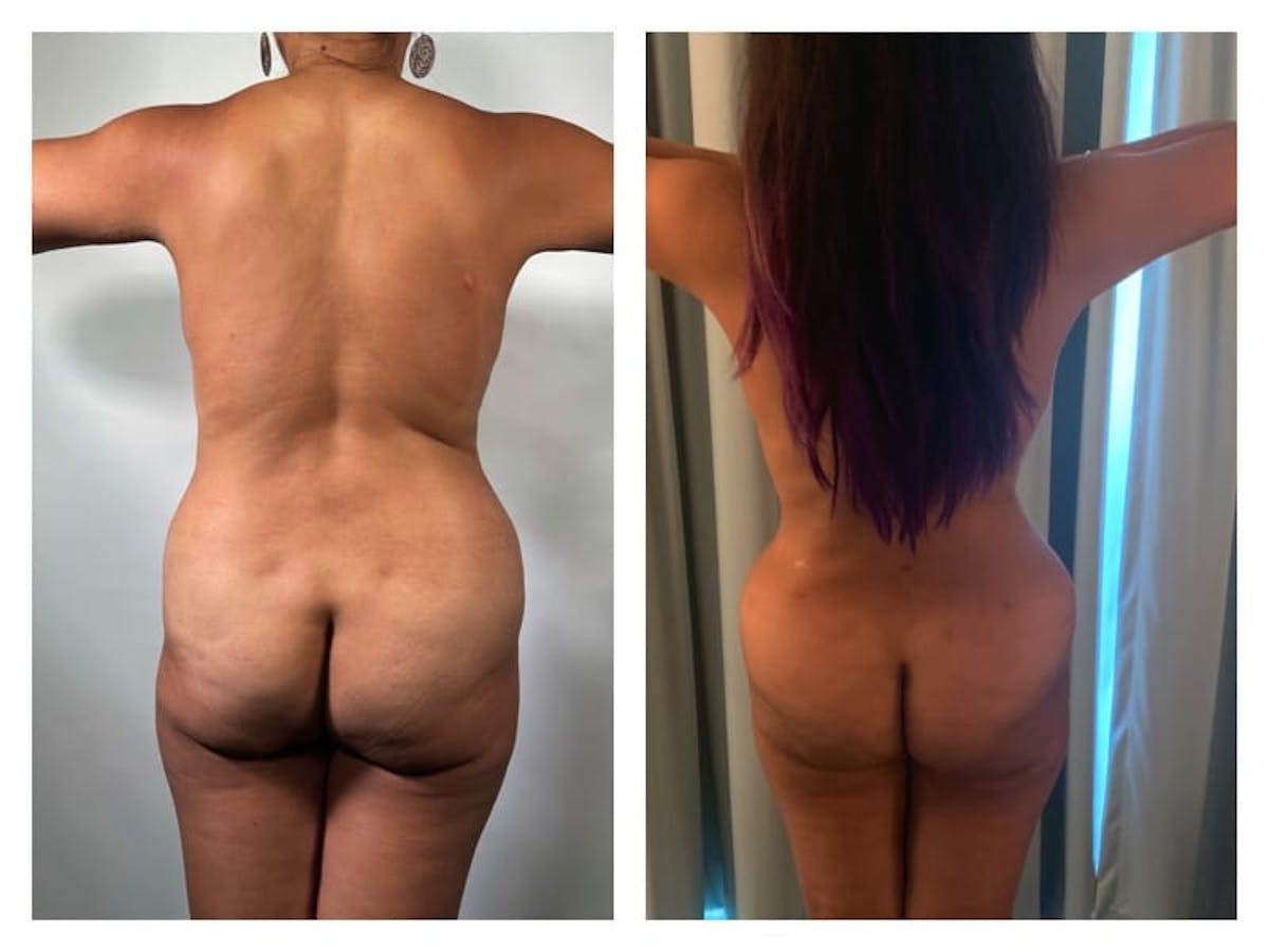 Mommy Makeover Before & After Gallery - Patient 133183803 - Image 2