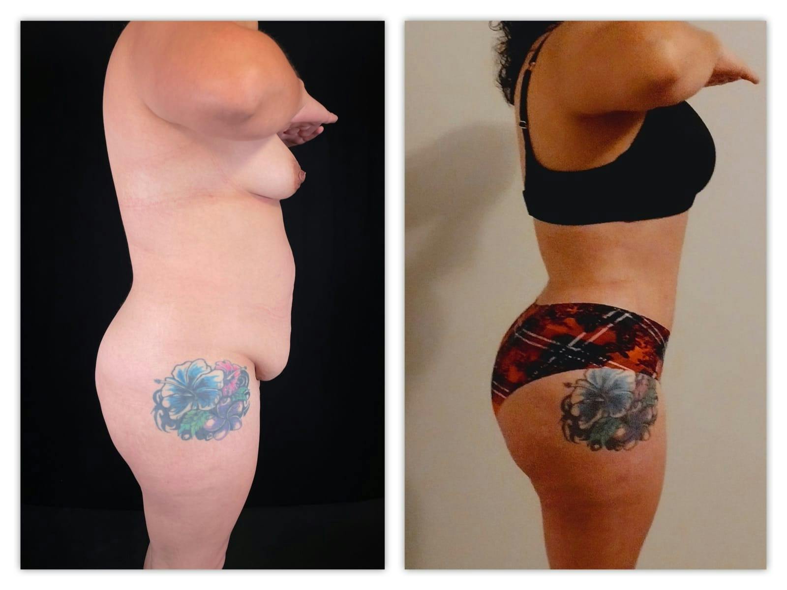 Tummy Tuck Before & After Gallery - Patient 133183800 - Image 2