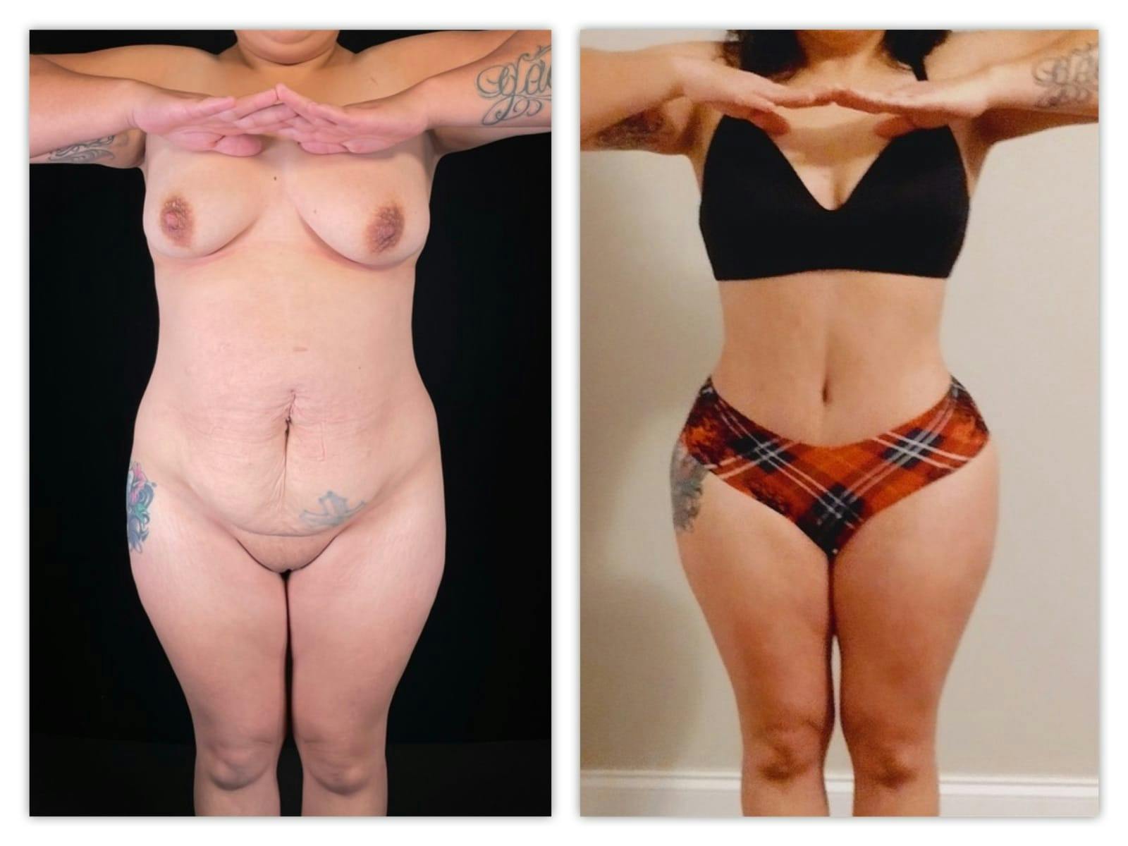 Tummy Tuck Before & After Gallery - Patient 133183800 - Image 1