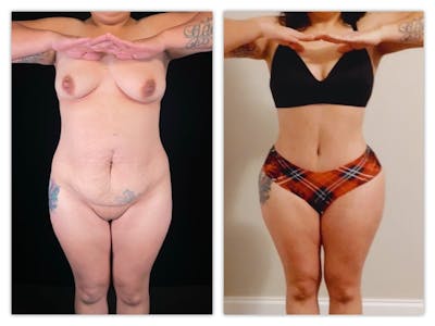 Tummy Tuck Before & After Gallery - Patient 133183800 - Image 1