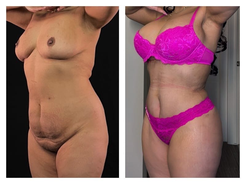 Mommy Makeover Before & After Gallery - Patient 133183790 - Image 3