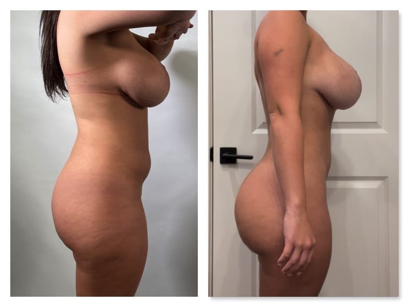 Brazilian Butt Lift Before & After Gallery - Patient 133183857 - Image 4