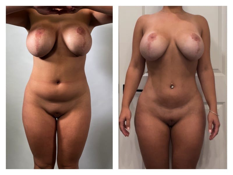 Brazilian Butt Lift Before & After Gallery - Patient 133183857 - Image 2