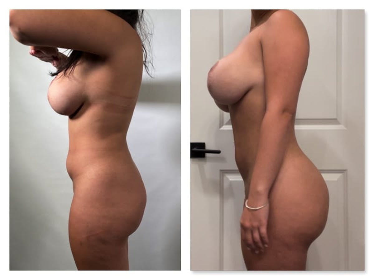 Brazilian Butt Lift Before & After Gallery - Patient 133183857 - Image 2