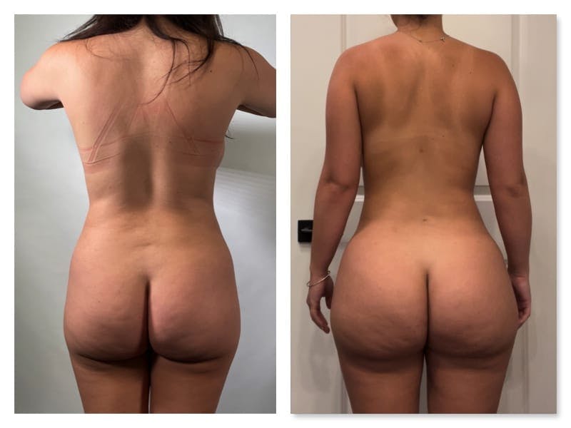 Brazilian Butt Lift Before & After Gallery - Patient 133183857 - Image 1