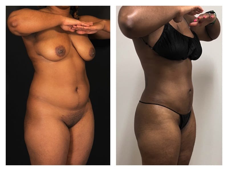 Liposuction Before & After Gallery - Patient 133183911 - Image 4