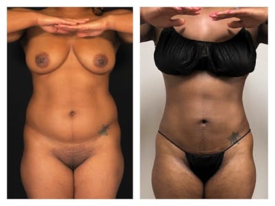 Liposuction Before & After Gallery - Patient 133183911 - Image 1