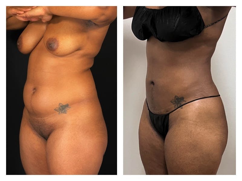 Liposuction Before & After Gallery - Patient 133183911 - Image 3