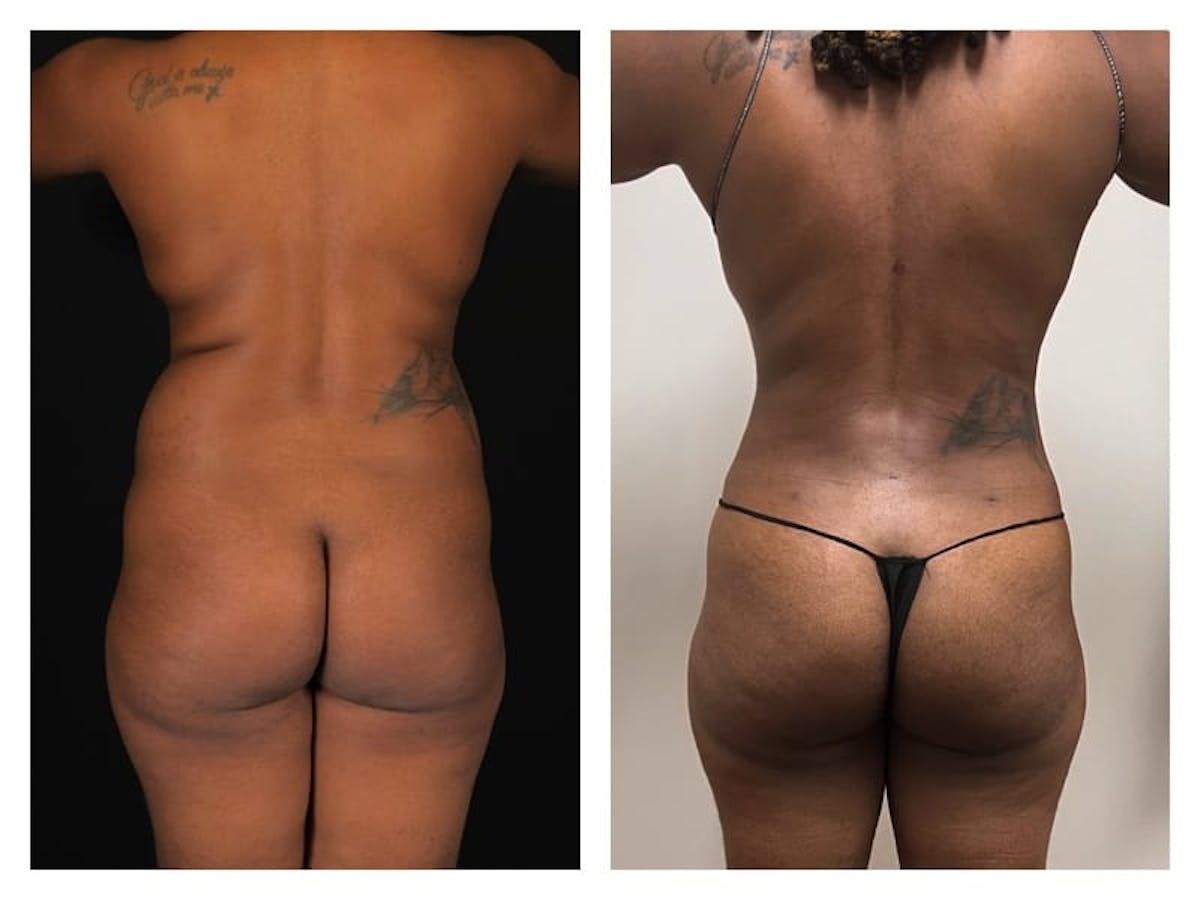 Liposuction Before & After Gallery - Patient 133183911 - Image 4