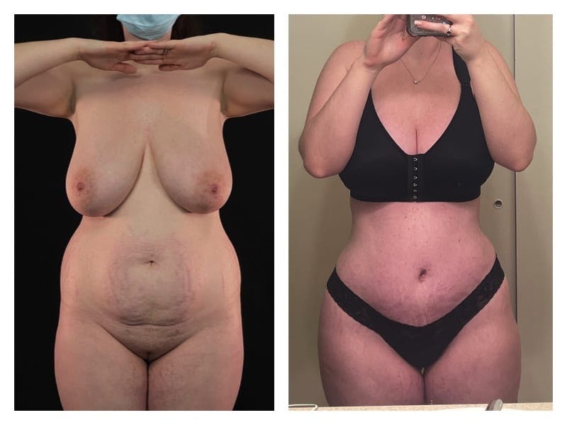 Mommy Makeover Before & After Gallery - Patient 133183836 - Image 1