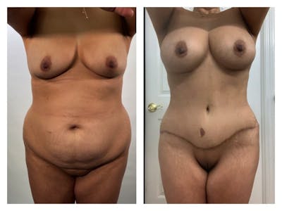 Mommy Makeover Before & After Gallery - Patient 133183931 - Image 1