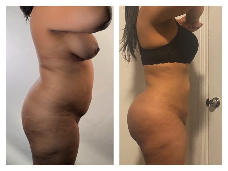 Brazilian Butt Lift Before & After Gallery - Patient 133183915 - Image 4