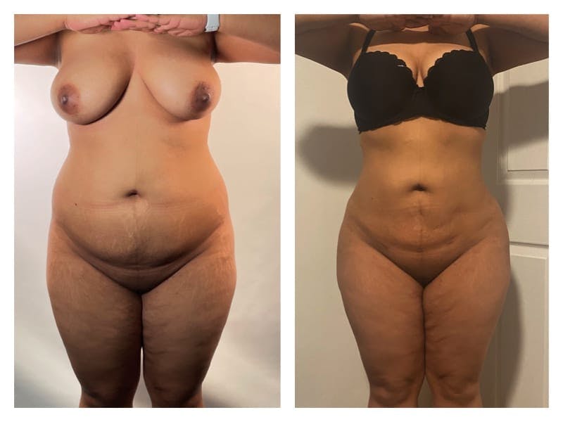 Liposuction Before & After Gallery - Patient 133183914 - Image 1