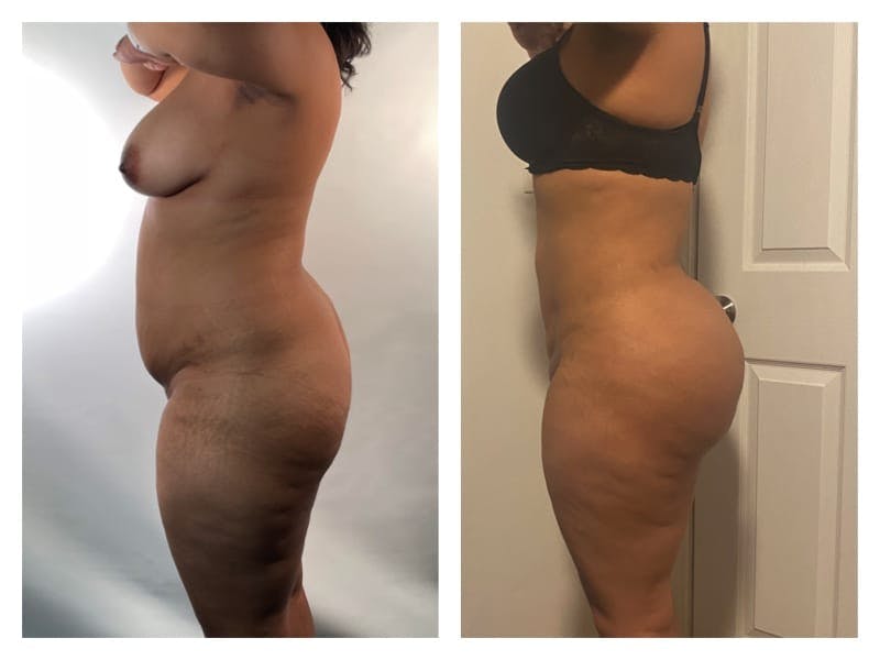 Brazilian Butt Lift Before & After Gallery - Patient 133183915 - Image 3
