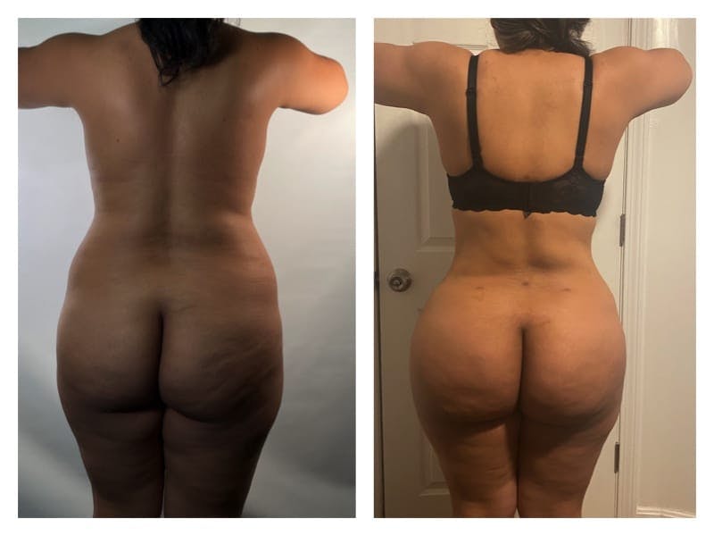 Brazilian Butt Lift Before & After Gallery - Patient 133183915 - Image 1
