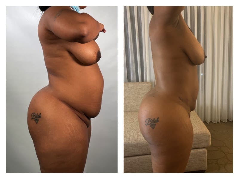 Brazilian Butt Lift Before & After Gallery - Patient 133183835 - Image 4