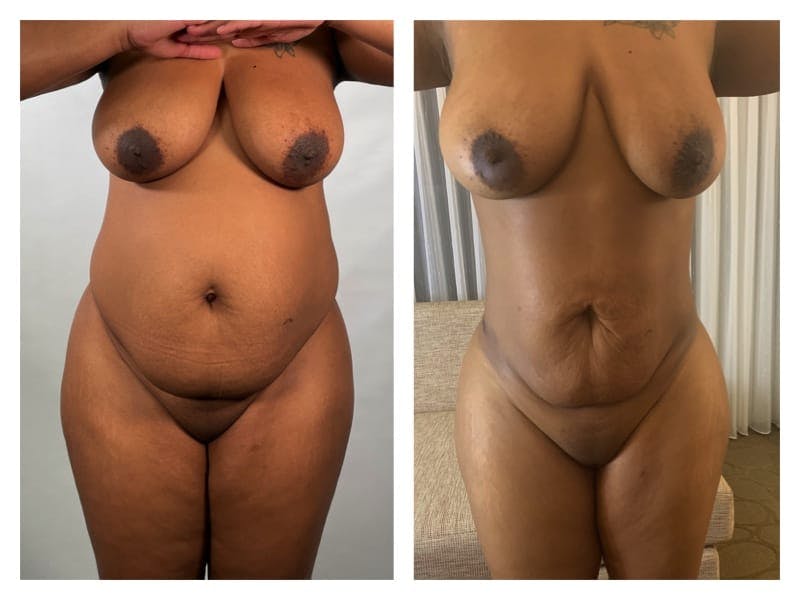 Brazilian Butt Lift Before & After Gallery - Patient 133183835 - Image 2