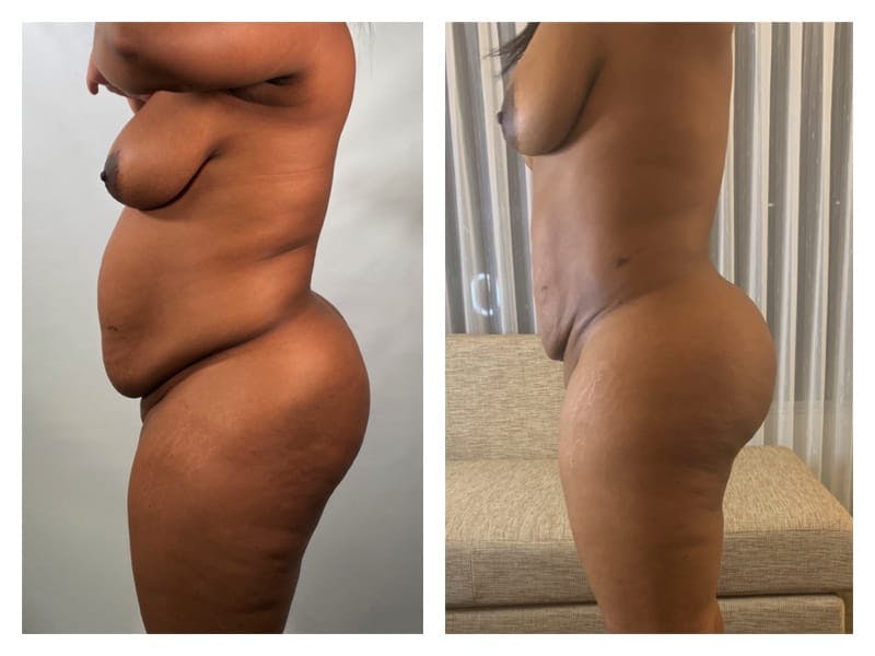 Brazilian Butt Lift Before & After Gallery - Patient 133183835 - Image 3