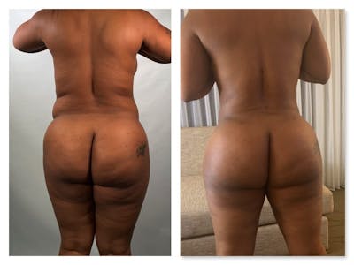 Brazilian Butt Lift Before & After Gallery - Patient 133183835 - Image 1