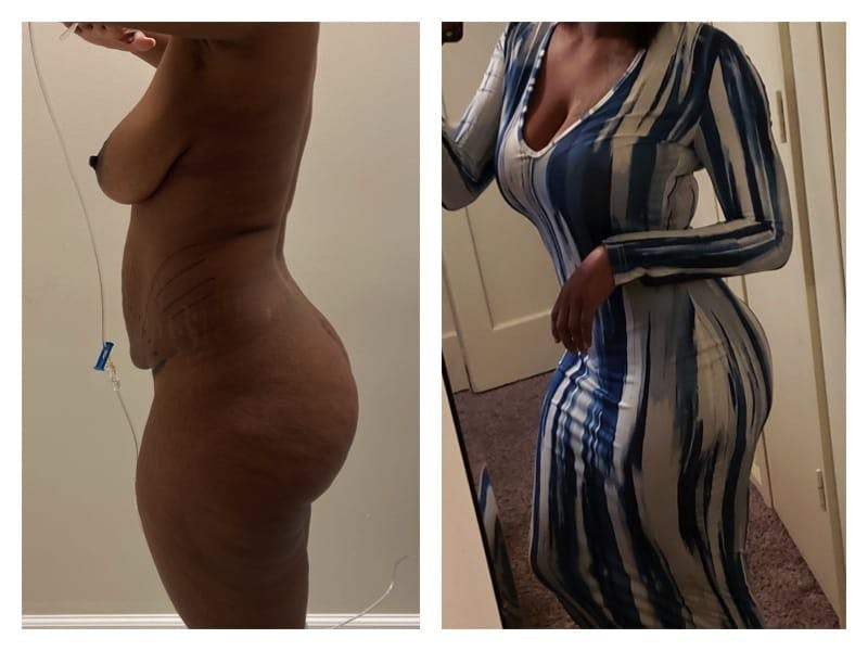 Tummy Tuck Before & After Gallery - Patient 133183929 - Image 4