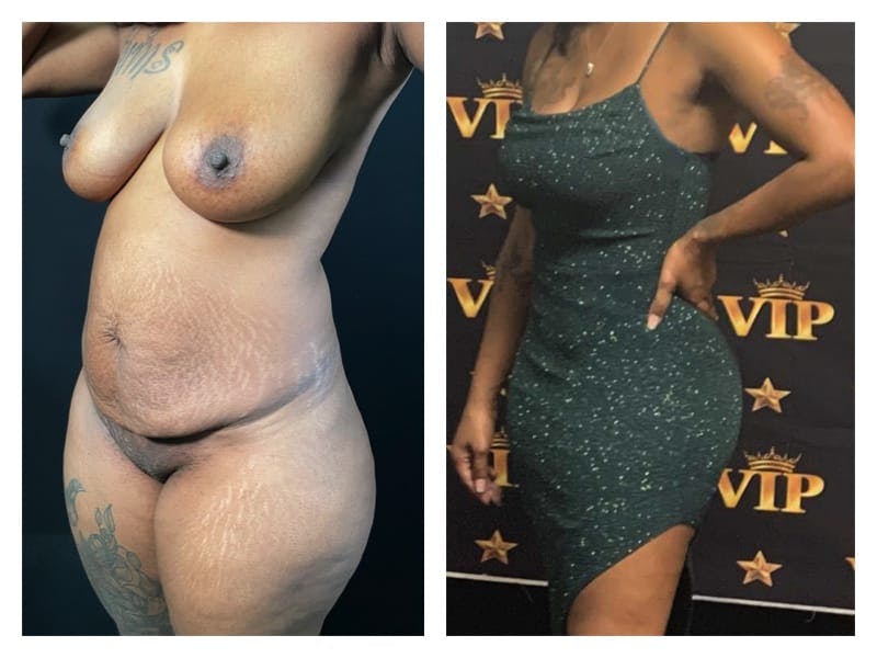 Tummy Tuck Before & After Gallery - Patient 133183929 - Image 2