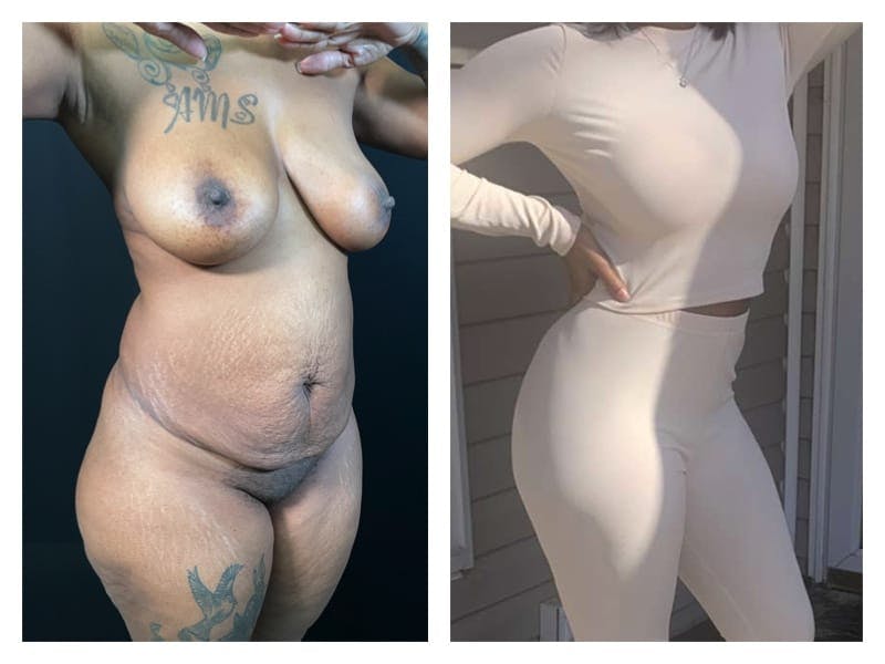 Tummy Tuck Before & After Gallery - Patient 133183929 - Image 3