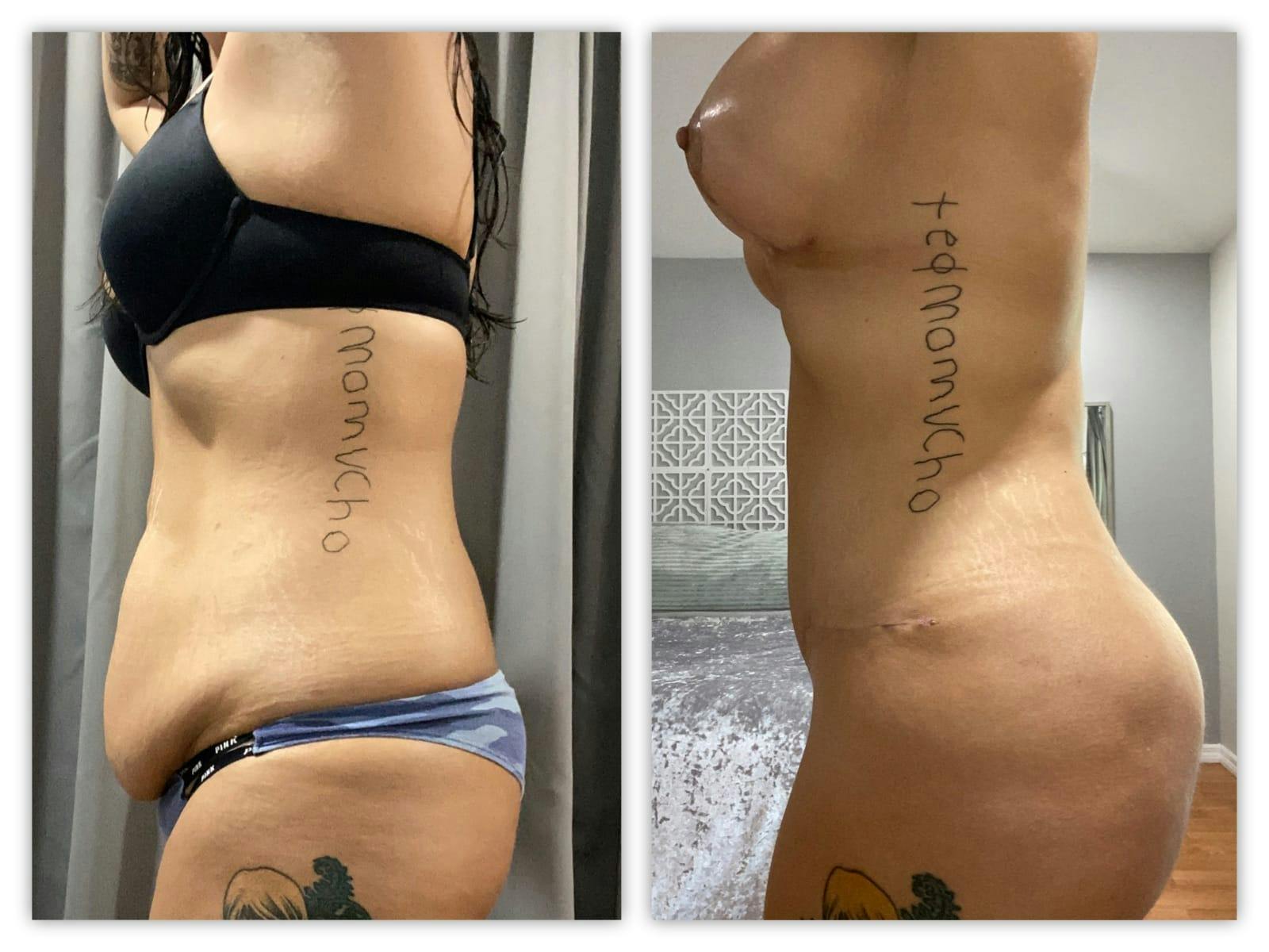 Mommy Makeover Before & After Gallery - Patient 133183834 - Image 3