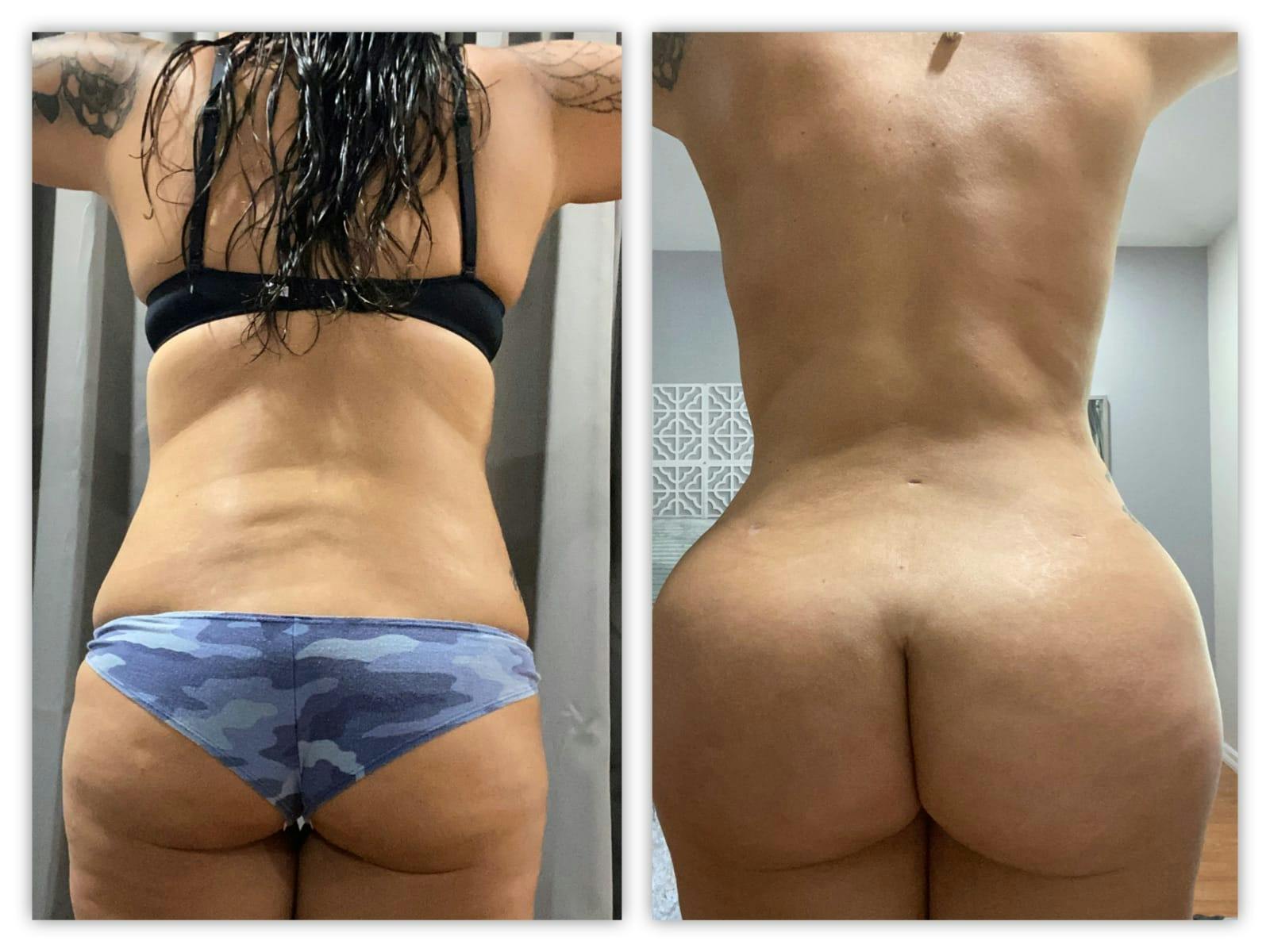 Mommy Makeover Before & After Gallery - Patient 133183834 - Image 2
