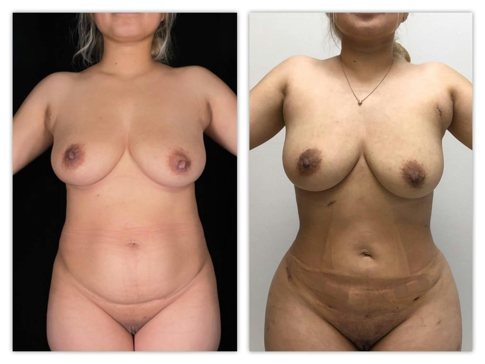 Brazilian Butt Lift Before & After Gallery - Patient 133182989 - Image 2