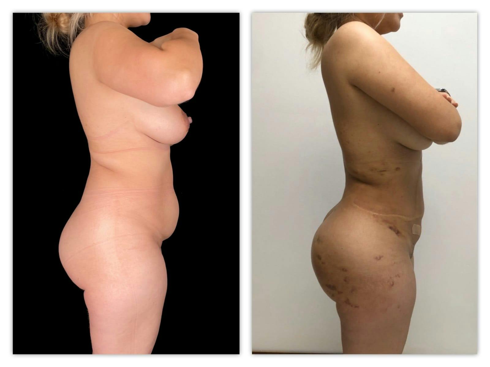 Brazilian Butt Lift Before & After Gallery - Patient 133182989 - Image 3