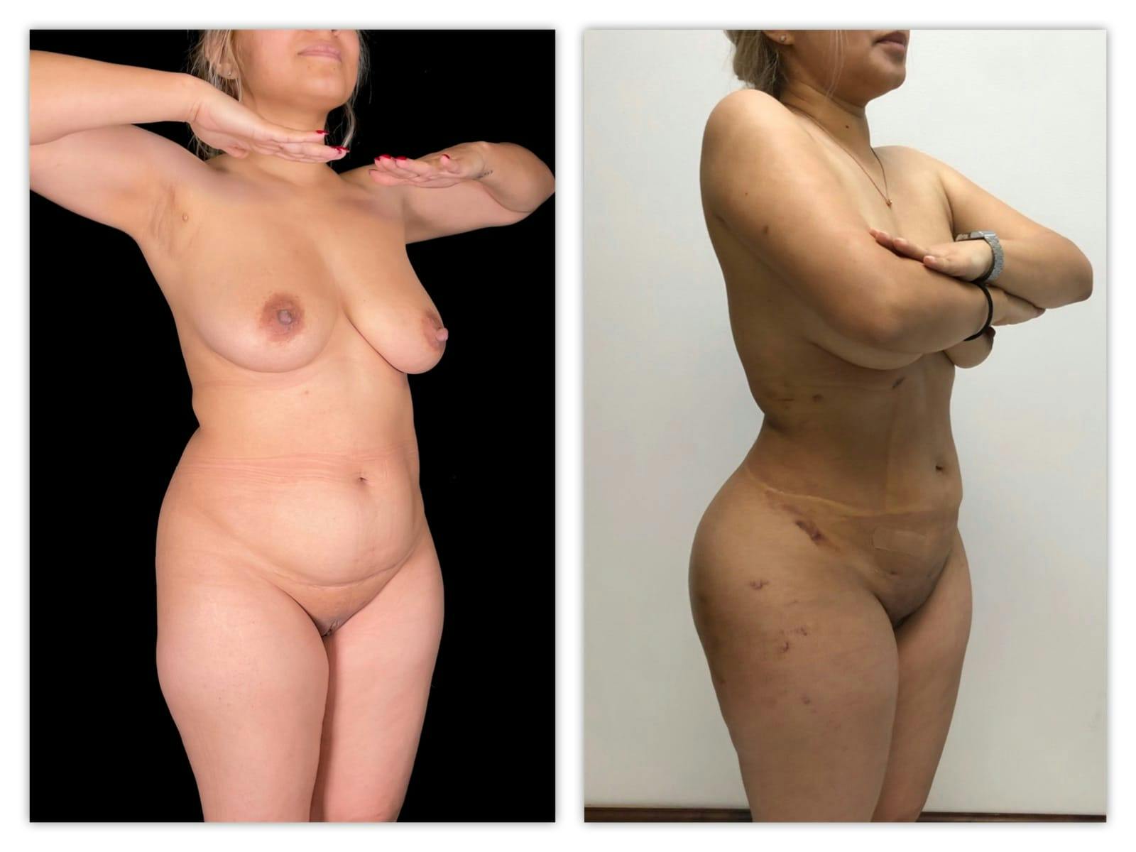Brazilian Butt Lift Before & After Gallery - Patient 133182989 - Image 4