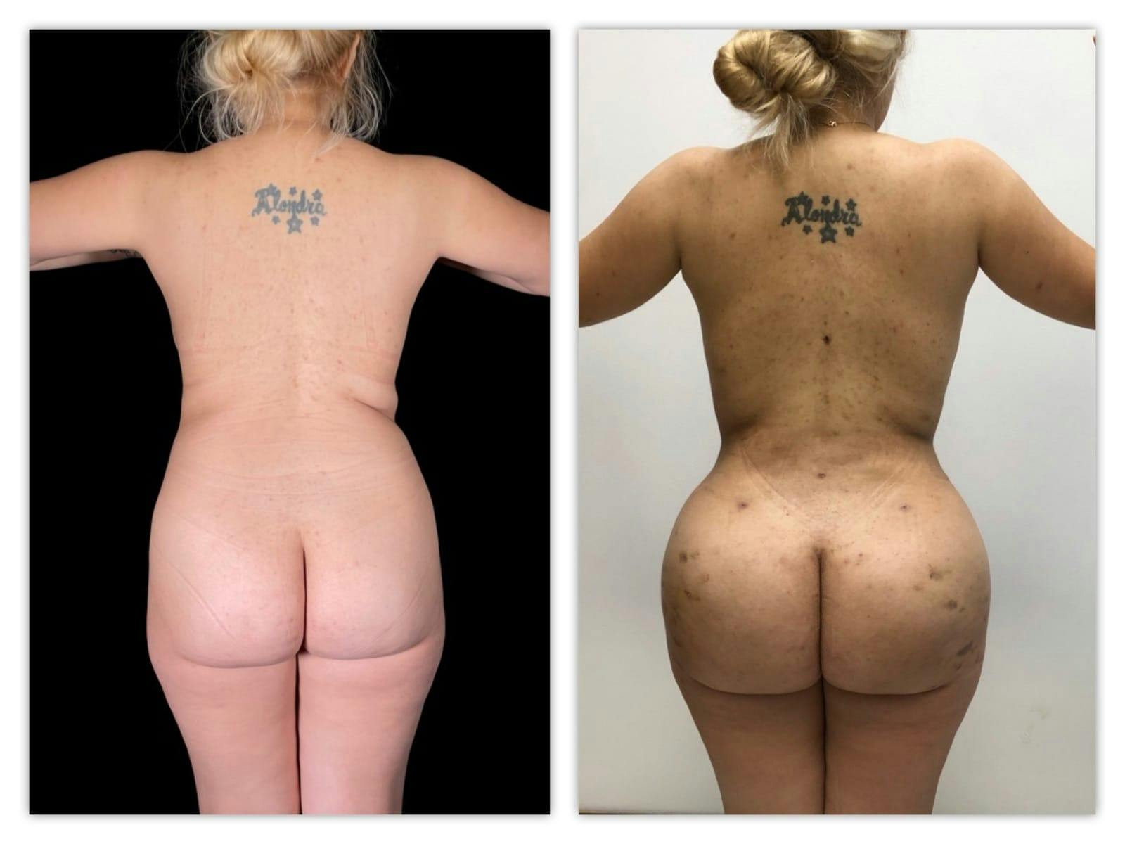 Brazilian Butt Lift Before & After Gallery - Patient 133182989 - Image 1