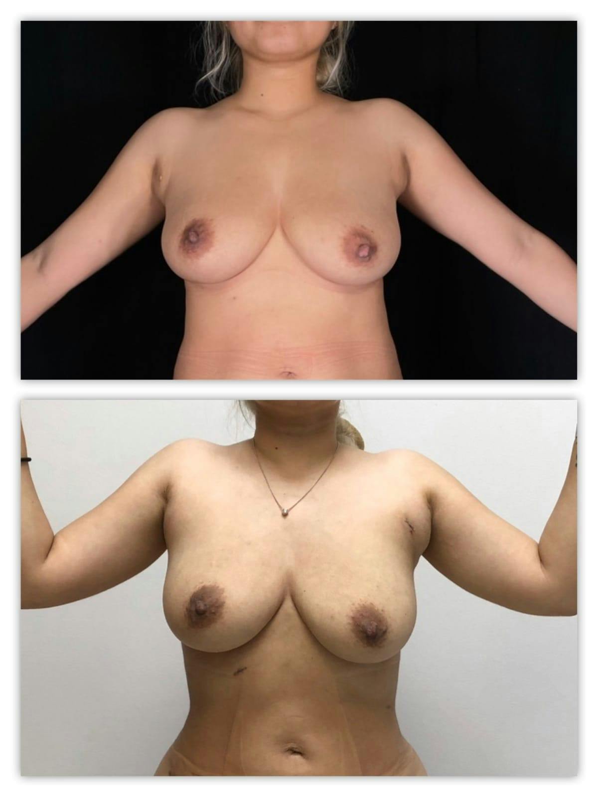 Brazilian Butt Lift Before & After Gallery - Patient 133182989 - Image 5