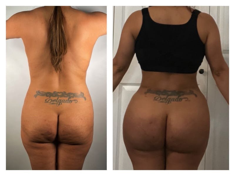 Brazilian Butt Lift Before & After Gallery - Patient 133182990 - Image 1
