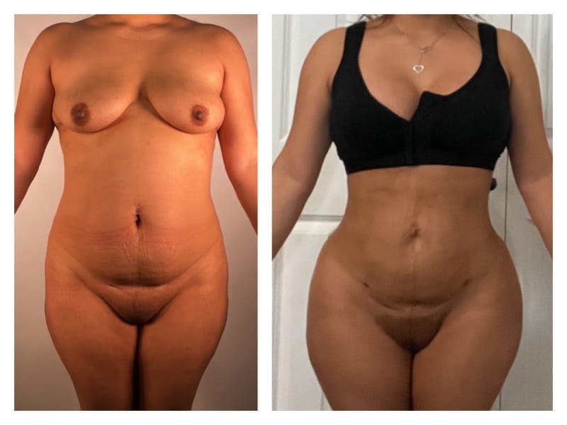 Brazilian Butt Lift Before & After Gallery - Patient 133182990 - Image 2