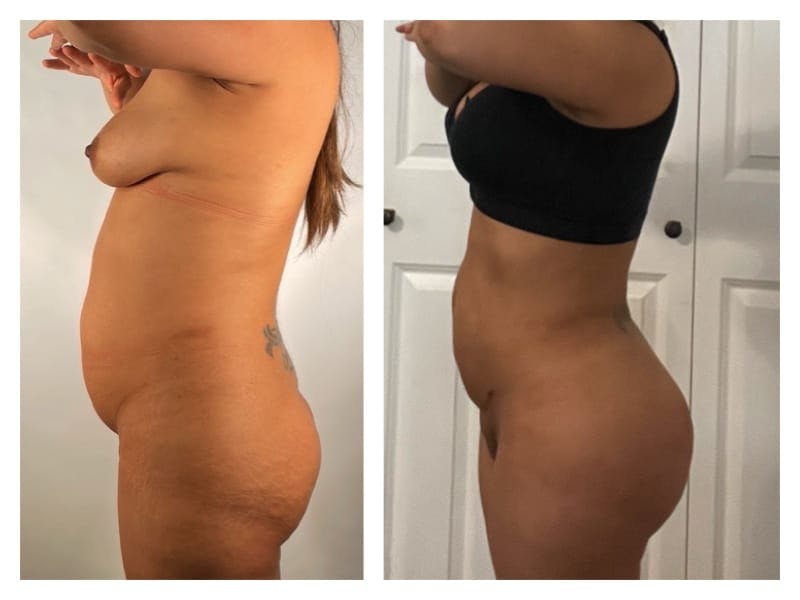 Brazilian Butt Lift Before & After Gallery - Patient 133182990 - Image 3