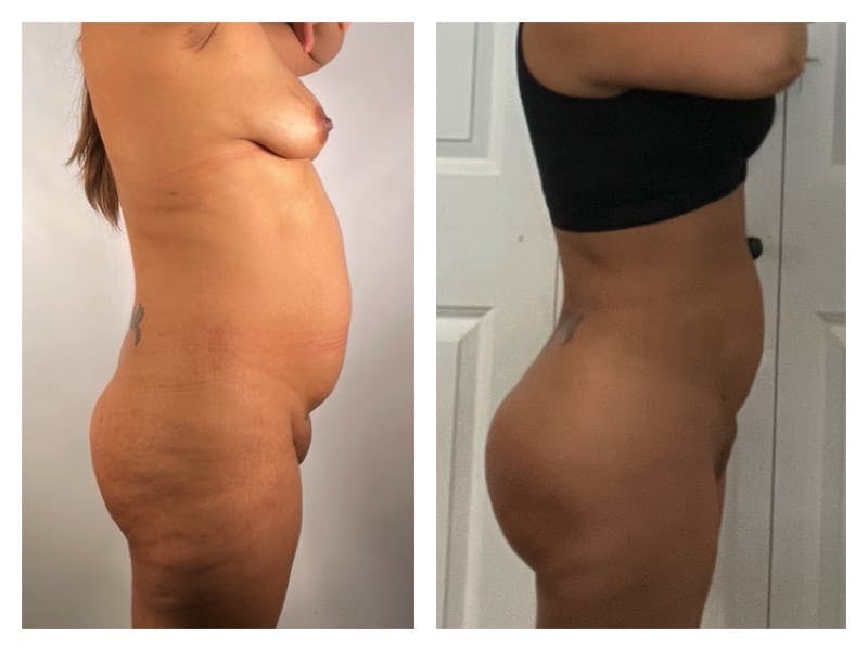 Brazilian Butt Lift Before & After Gallery - Patient 133182990 - Image 4