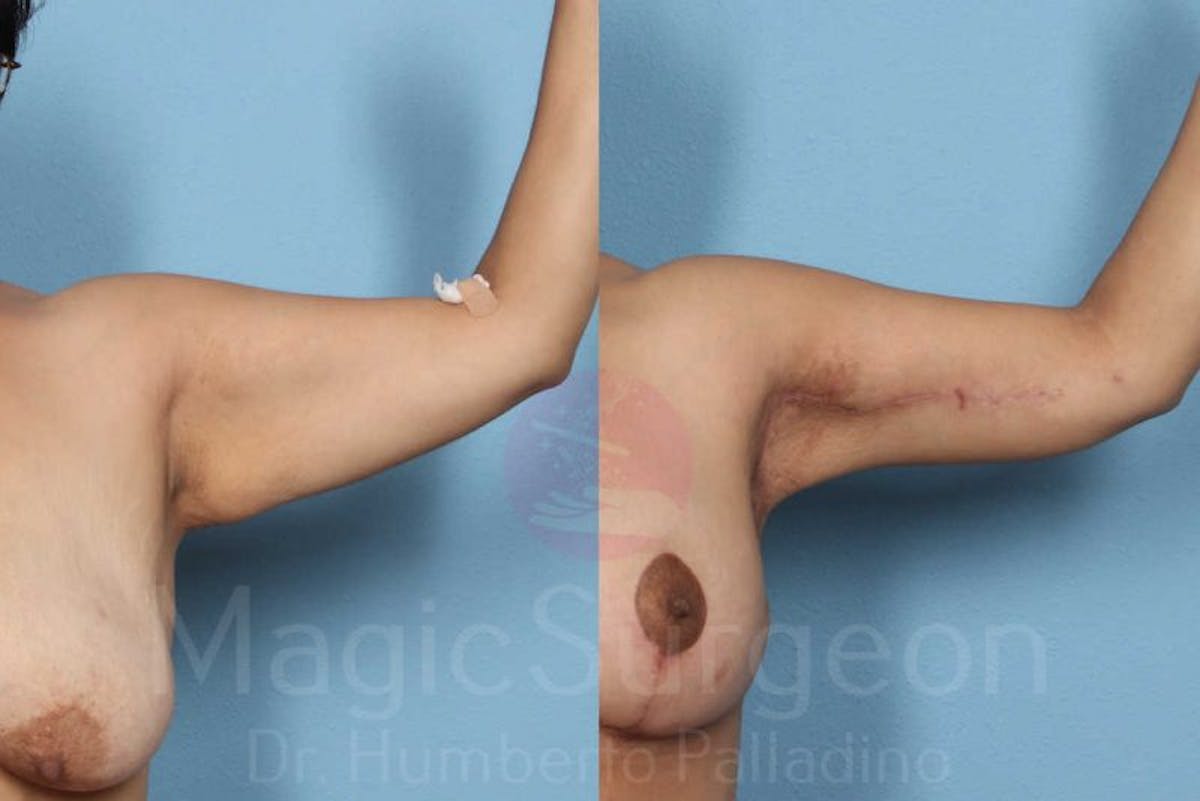 Arm Lift Before & After Gallery - Patient 133182237 - Image 4