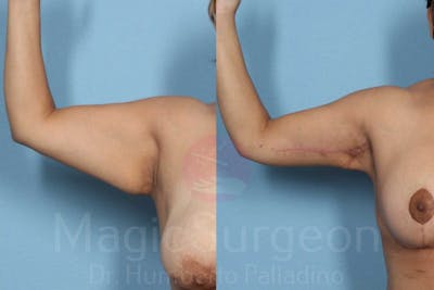 Arm Lift Before & After Gallery - Patient 133182237 - Image 1